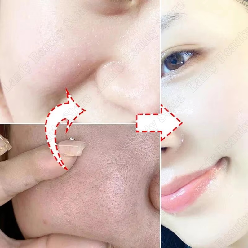 Creme de Ácido Salicílico para - Salicylic Acid Blackhead Remover avaliação e preço