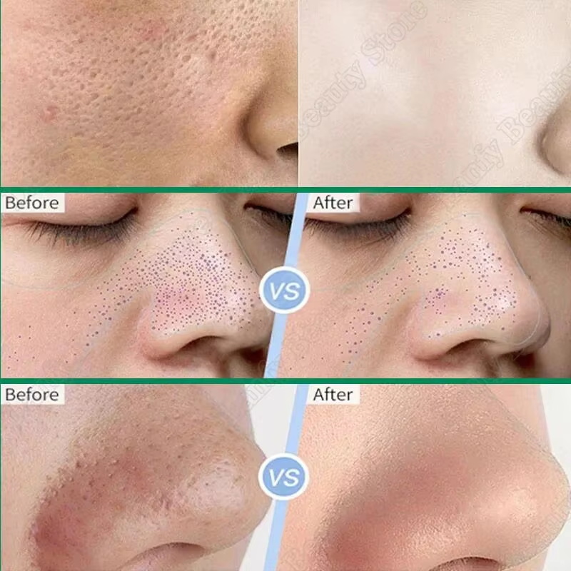Creme de Ácido Salicílico para - Salicylic Acid Blackhead Remover avaliação e preço